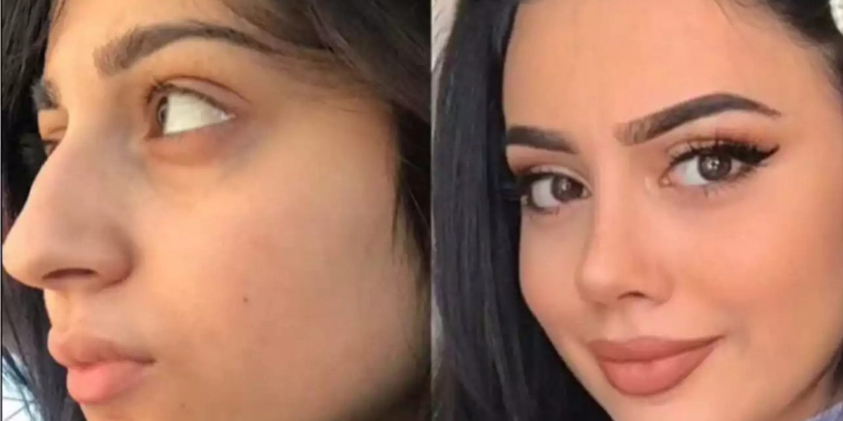 Your Guide to the Best Doctors in Dubai Performing Rhinoplasty