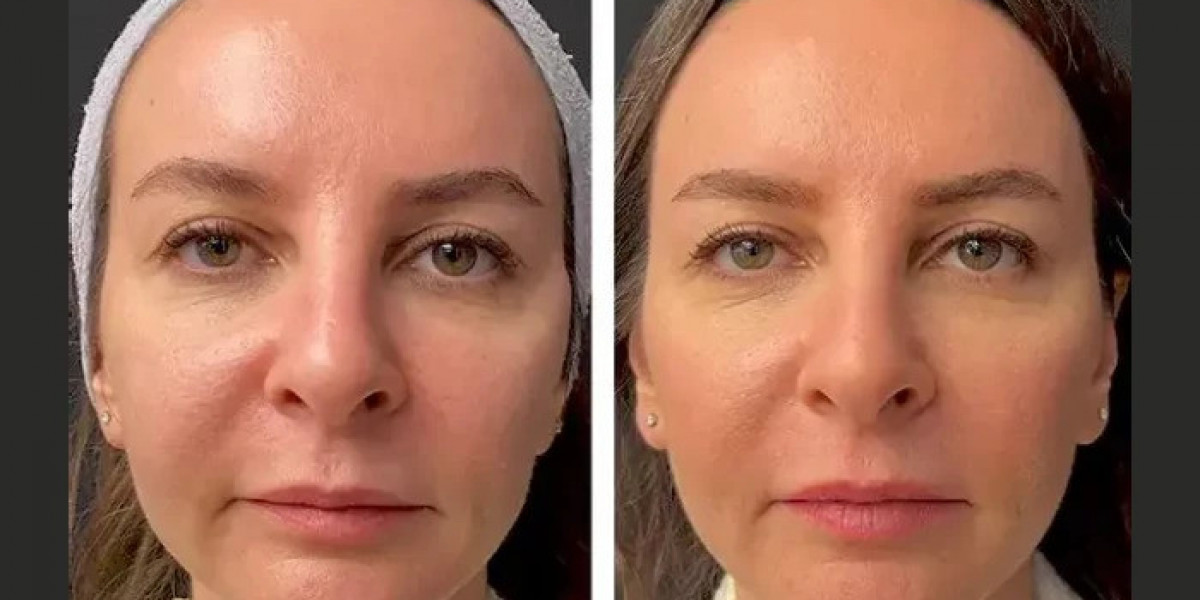 Best Plastic Surgeon in Dubai Using Mesotherapy for Skin Rejuvenation