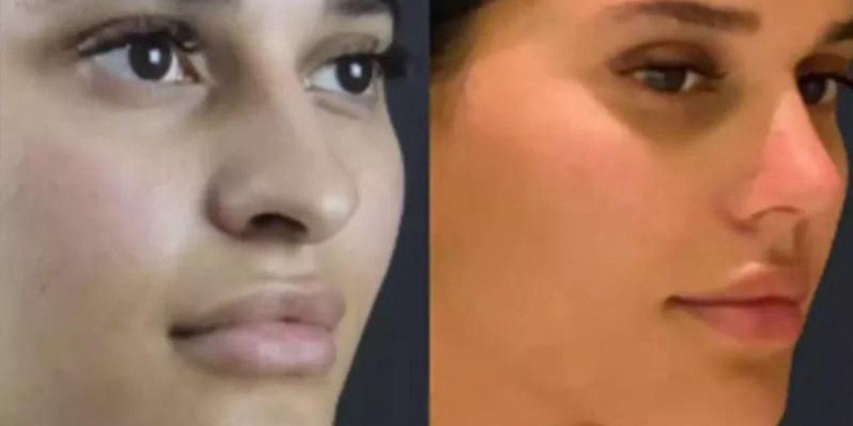 Septoplasty in Dubai: What to Expect During Recovery