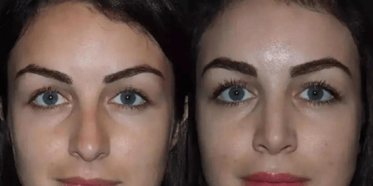 The Psychological Benefits of Rhinoplasty in Dubai