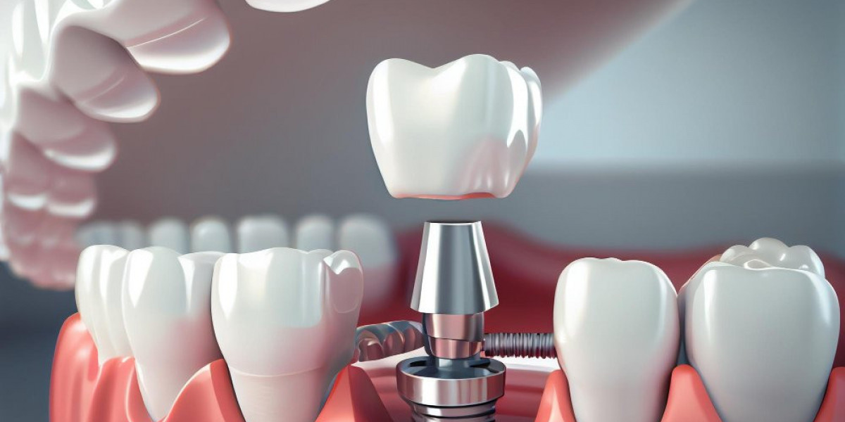 Turn Tooth Loss into Triumph with Dental Implants Dubai