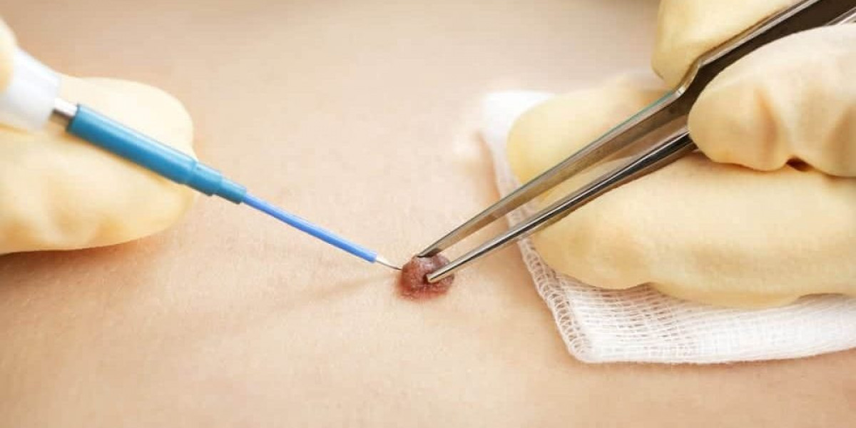 Skin Wart Removal: What You Need to Know