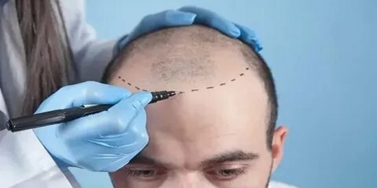 Permanent Hair Solutions with Hair Transplant in Islamabad