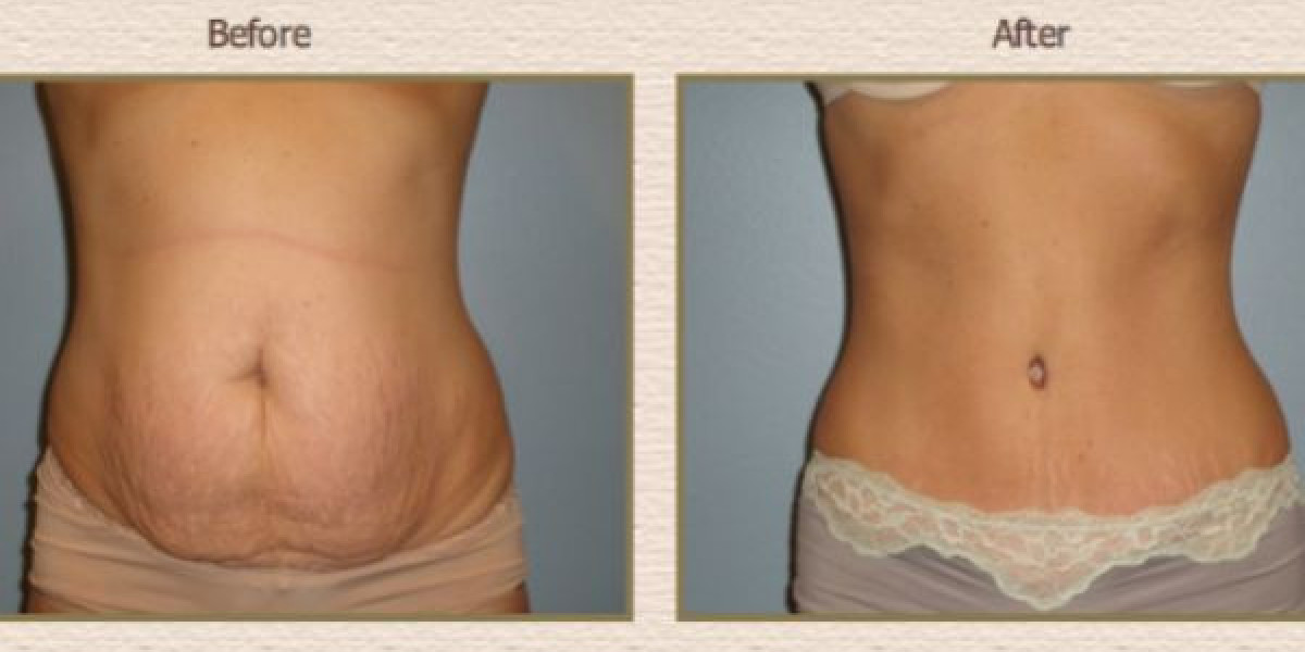 Before You Get a Tummy Tuck in Islamabad: Photos & Reviews