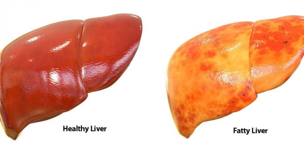Cirrhosis vs. Fatty Liver – Key Differences, Causes, and Treatment