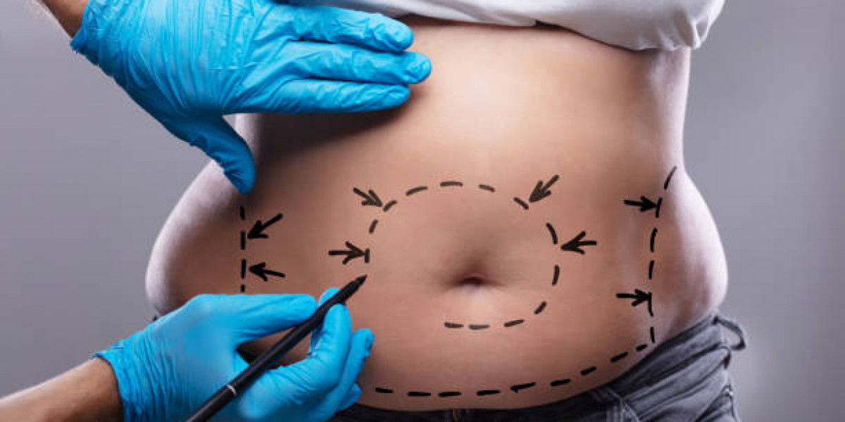 Liposuction in Riyadh: The Latest Laser Techniques