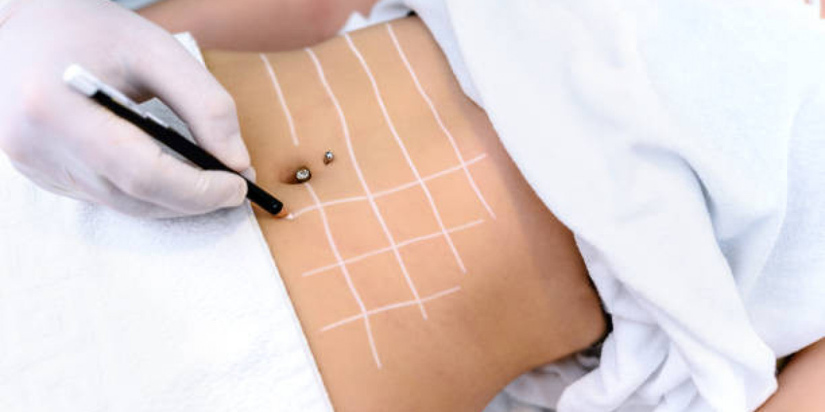 Understanding Liposuction Cost Factors Before Your Procedure