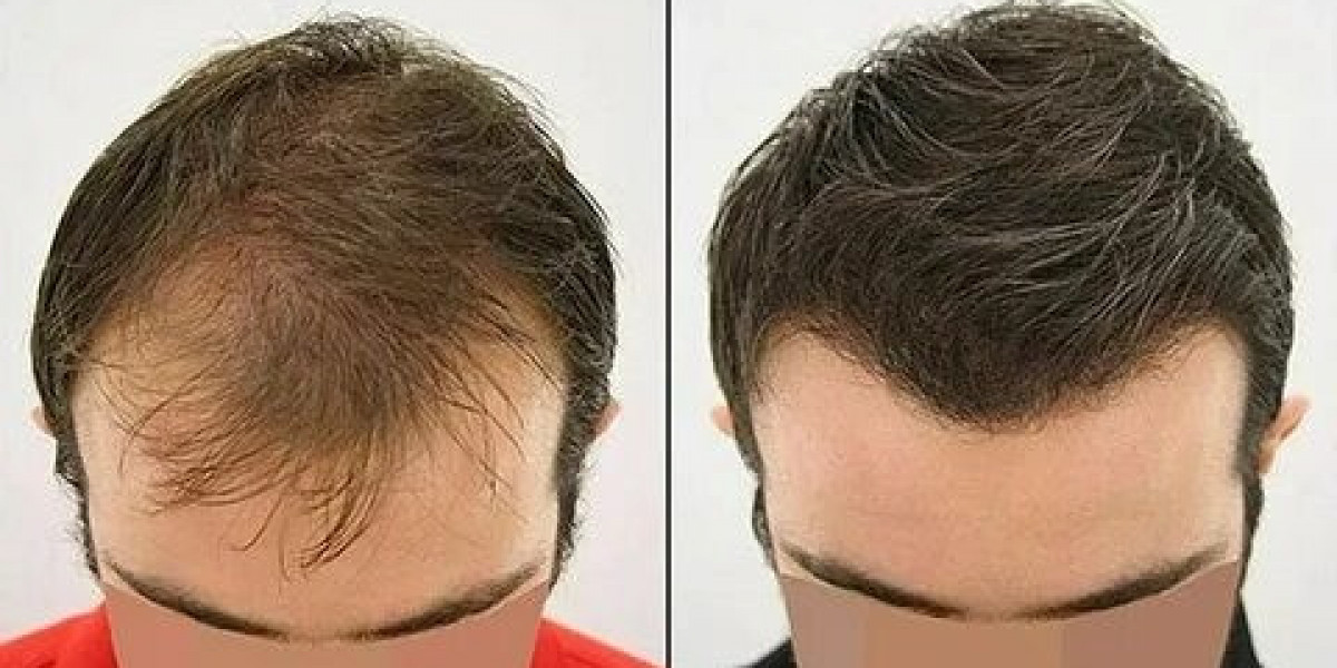 Hair Transplant in Islamabad – A Permanent Solution to Hair Loss