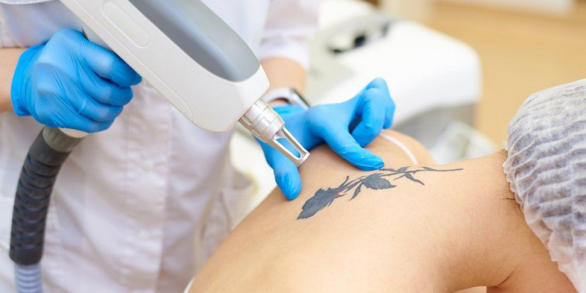 Can Laser Tattoo Removal Restore Natural Beauty Beyond Imagination?