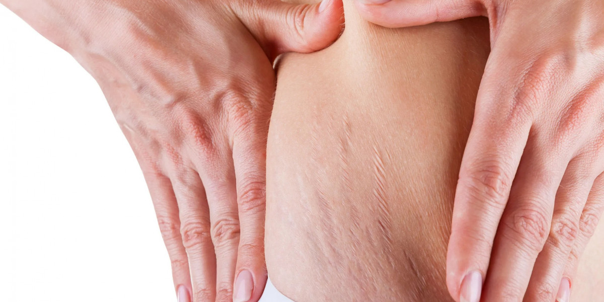 Why Choose Laser Stretch Marks Treatment in Dubai?