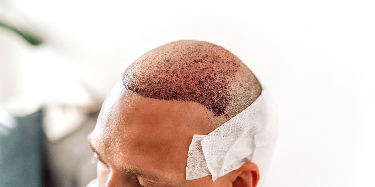 Transform Your Look with a Natural and Permanent Hair Transplant in Islamabad
