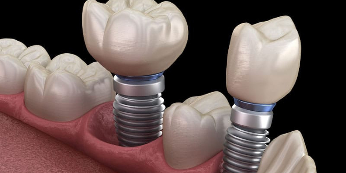 How Do Dental Implants Help Restore Natural-Looking Teeth?
