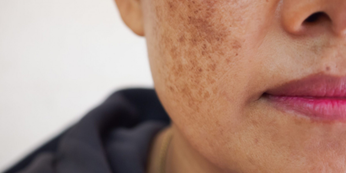 Bright Radiance Found Within Through Melasma Treatment