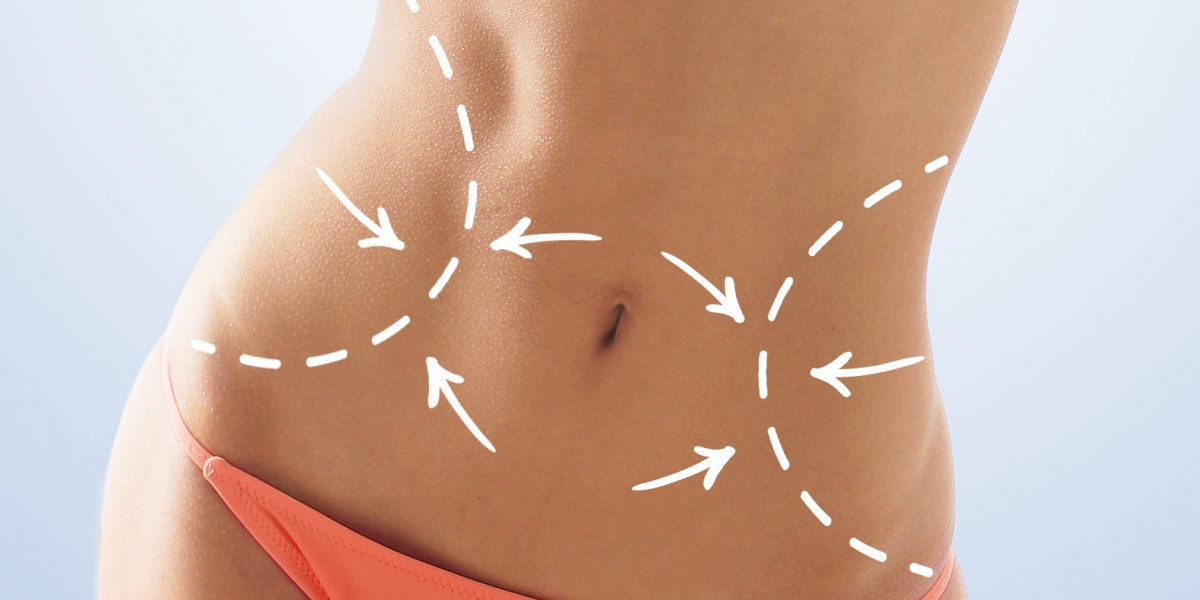 Personalized Liposuction Plans in Riyadh