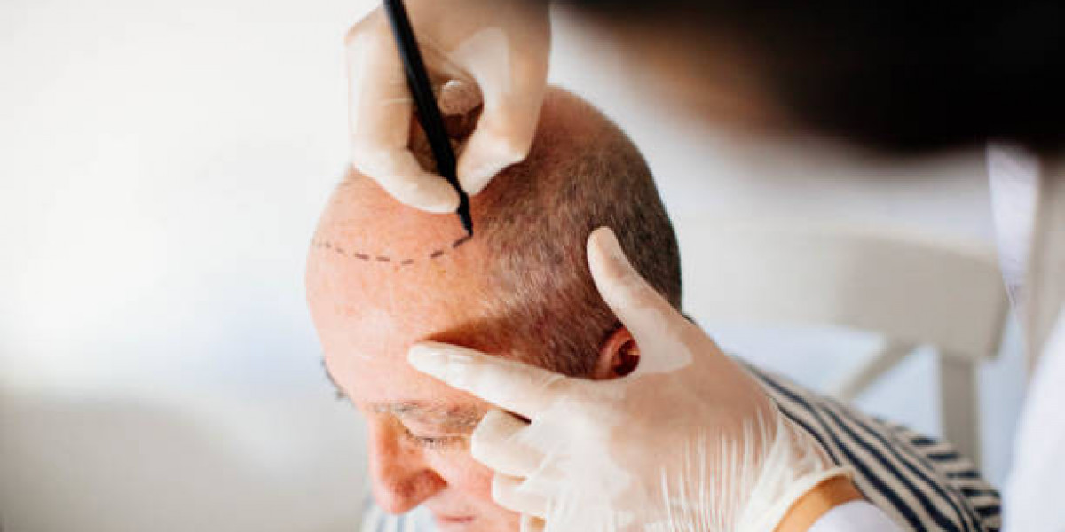 Premier Hair Restoration in Riyadh: Defining Quality and Long-Term Value