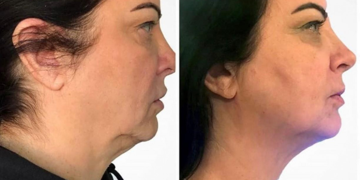 Understanding Endolift Technology in Skincare