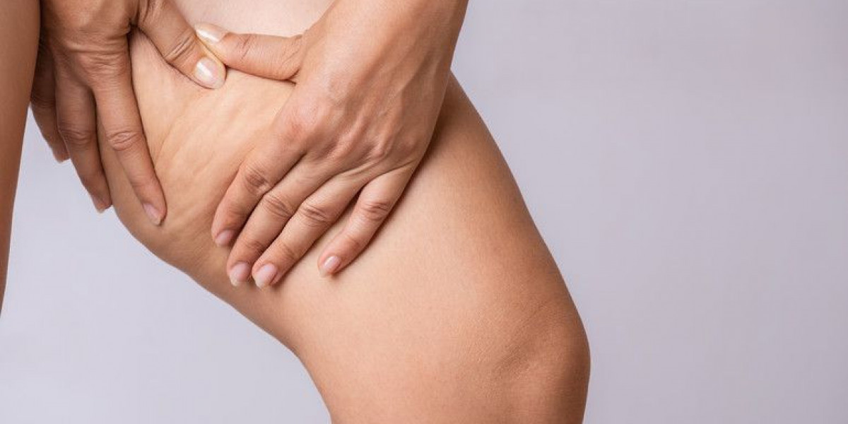 Advanced Lipedema Fat Removal in Riyadh