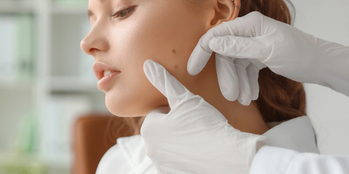 How Effective Is Skin Tag Removal in Dubai?