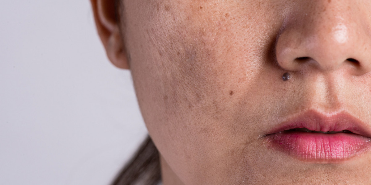 Flawless Glow: Melasma Solutions in Islamabad
