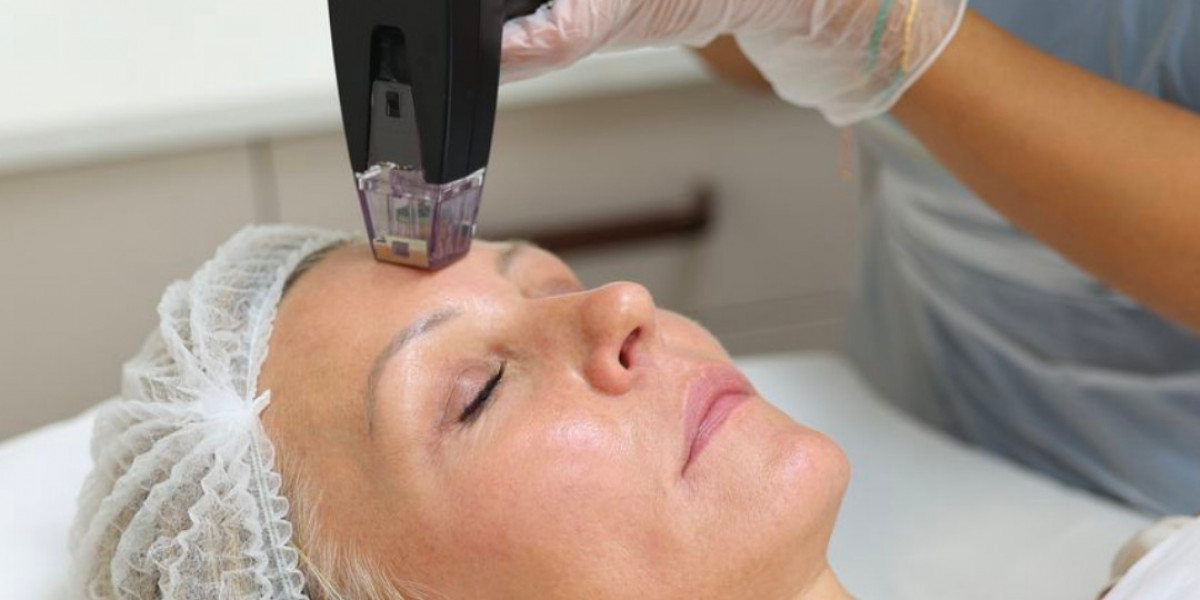 Morpheus8 for Acne Scars: Before and After Guide