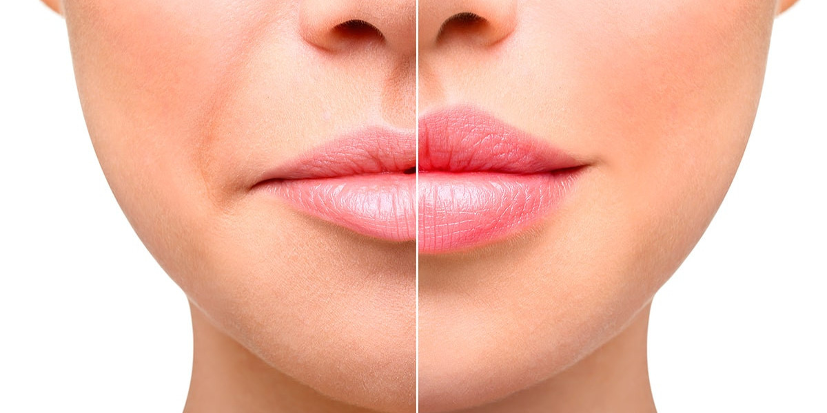 Choosing Between Upper, Lower, or Both Lips Enhancement