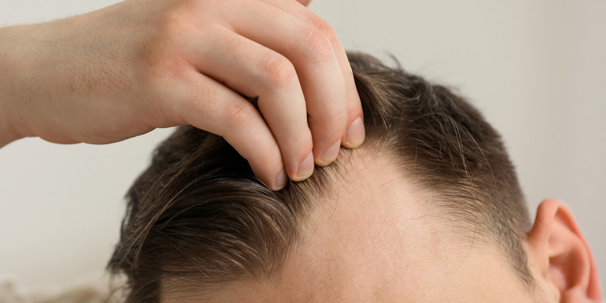 Who Sees Permanent Hair Growth With Finasteride in Dubai
