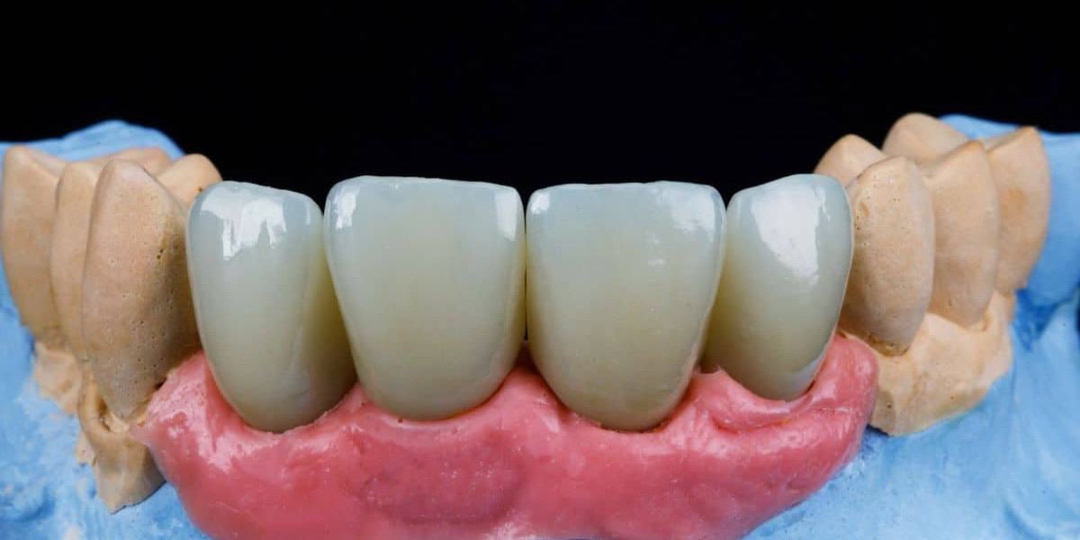 How Dentists Decide Between Crowns and Bridges