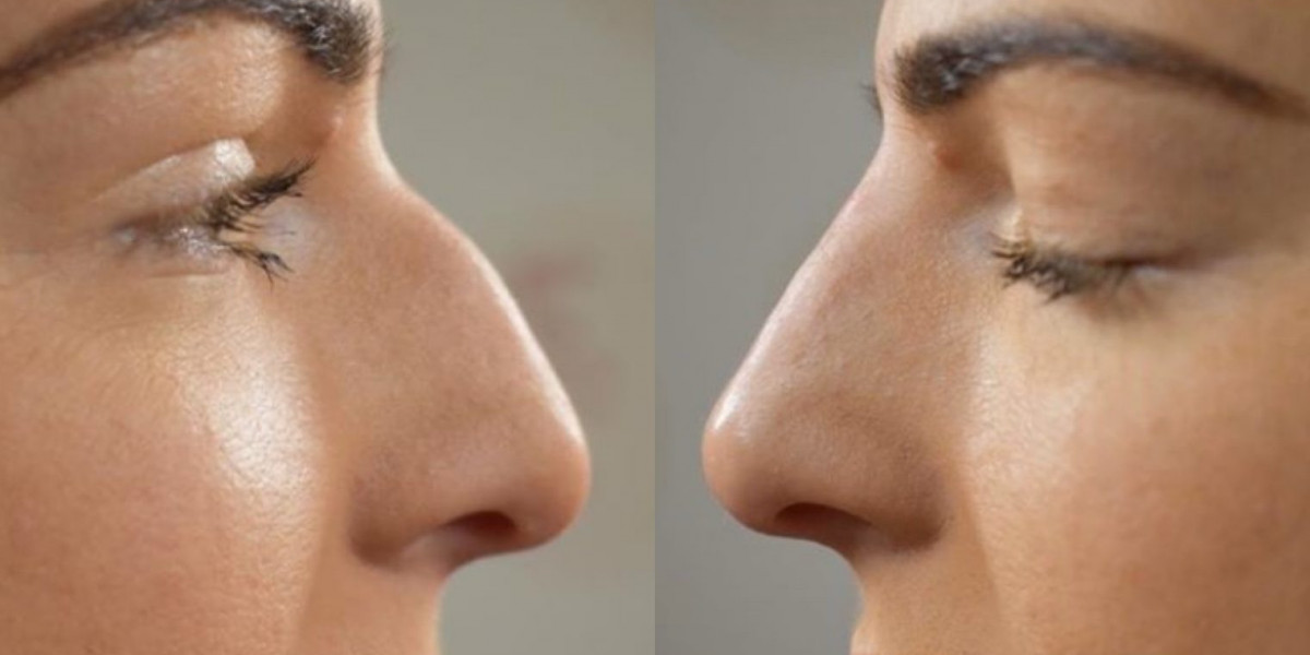 Non-Surgical Nose Job: How Much Filler Do You Need?