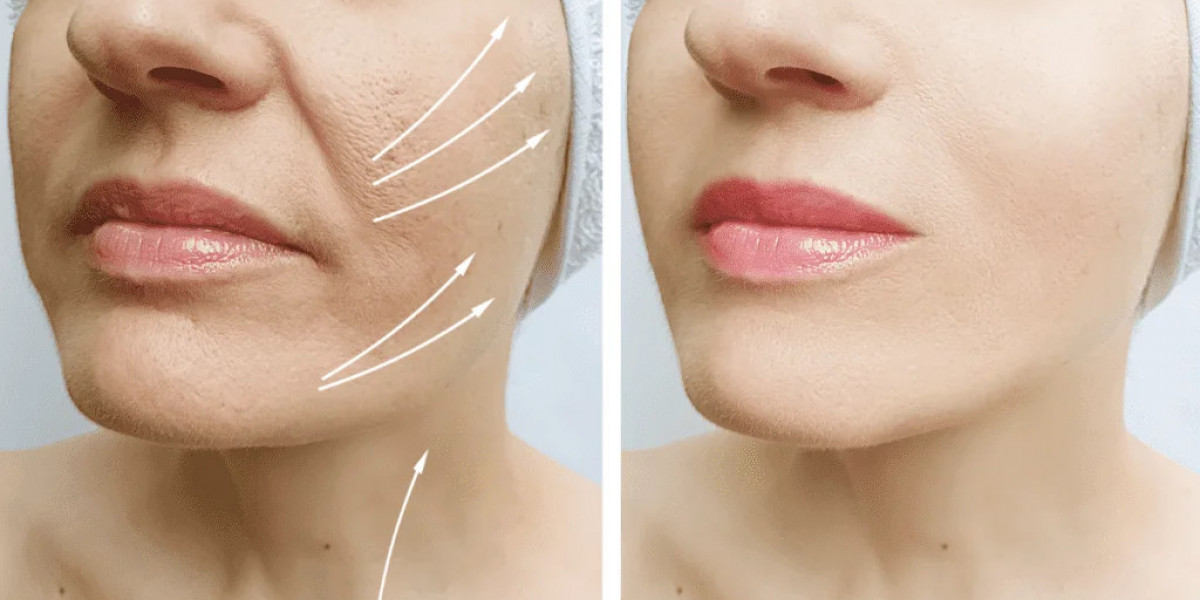 Facelift Surgery and Long-Term Facial Rejuvenation