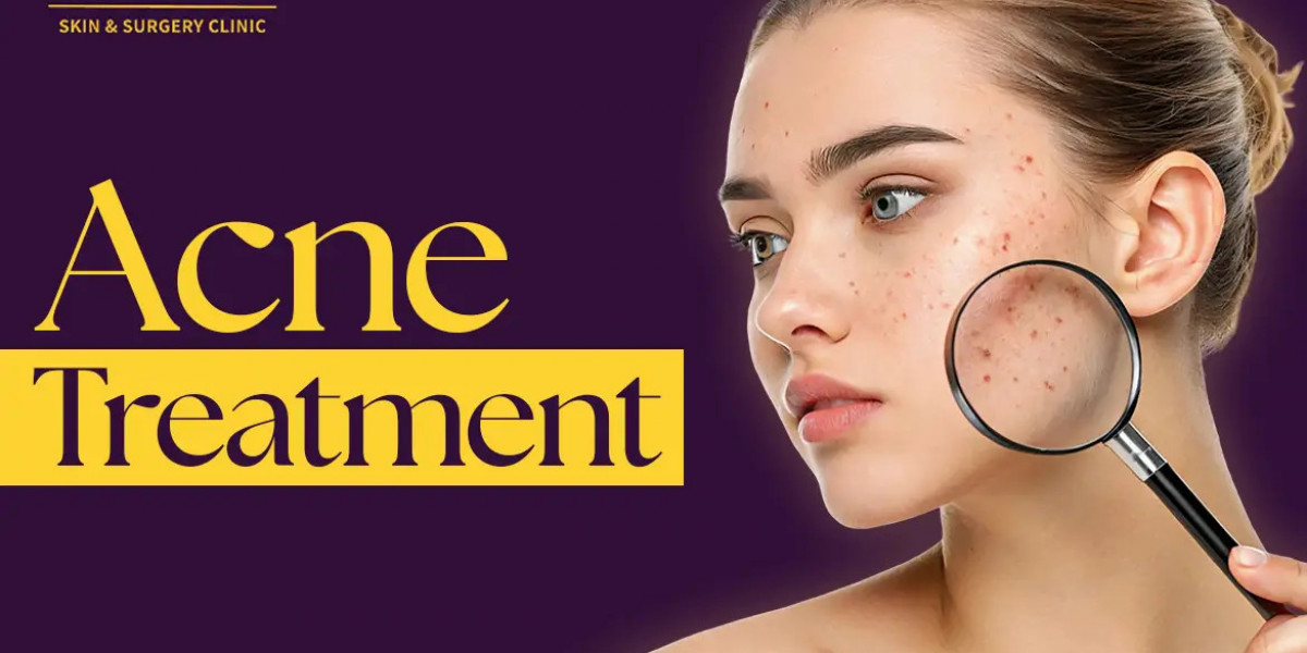 Acne Treatment - What is Pigmentation and Best Clinic for Pigmentation Treatment in Noida
