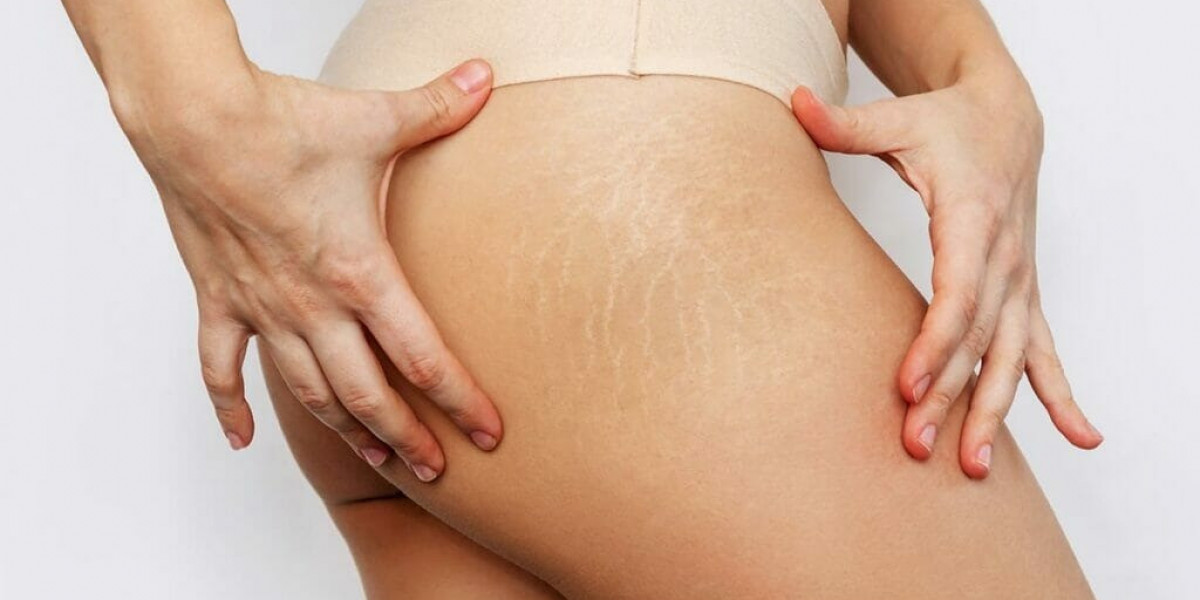 What Makes Laser Stretch Marks Treatment in Dubai Clinically Effective?