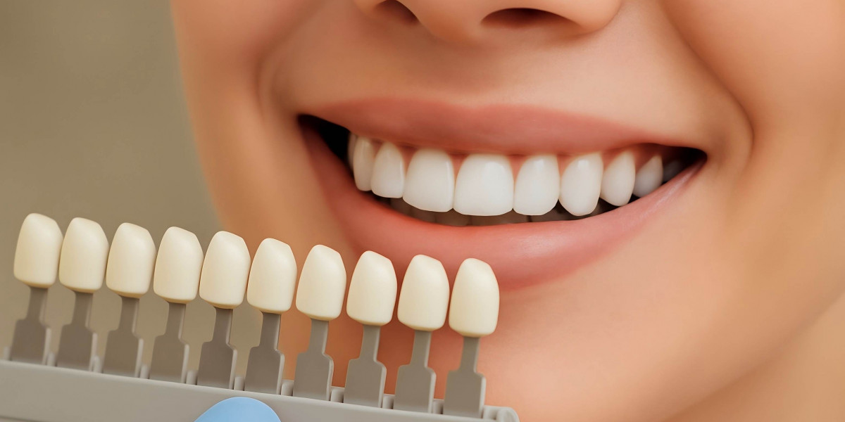 Make Your Smile Shine Brighter with Composite Veneers