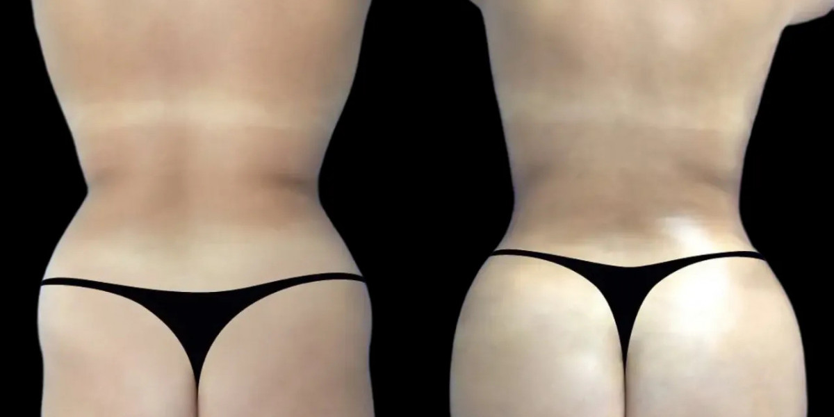 Best Plastic Surgeon in dubai: Hyacorp Fillers with Minimal Downtime