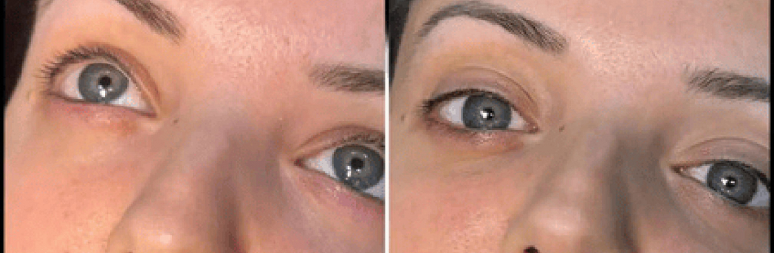 dermal fillers Cover Image