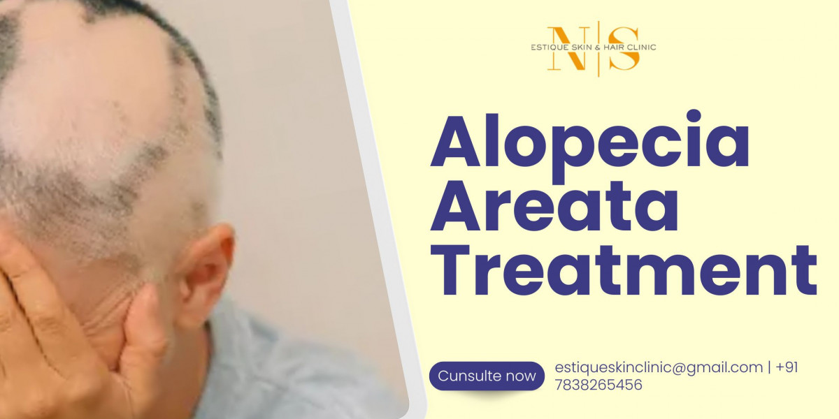 Alopecia Areata in Men: Spotting the Early Signs and Taking Control