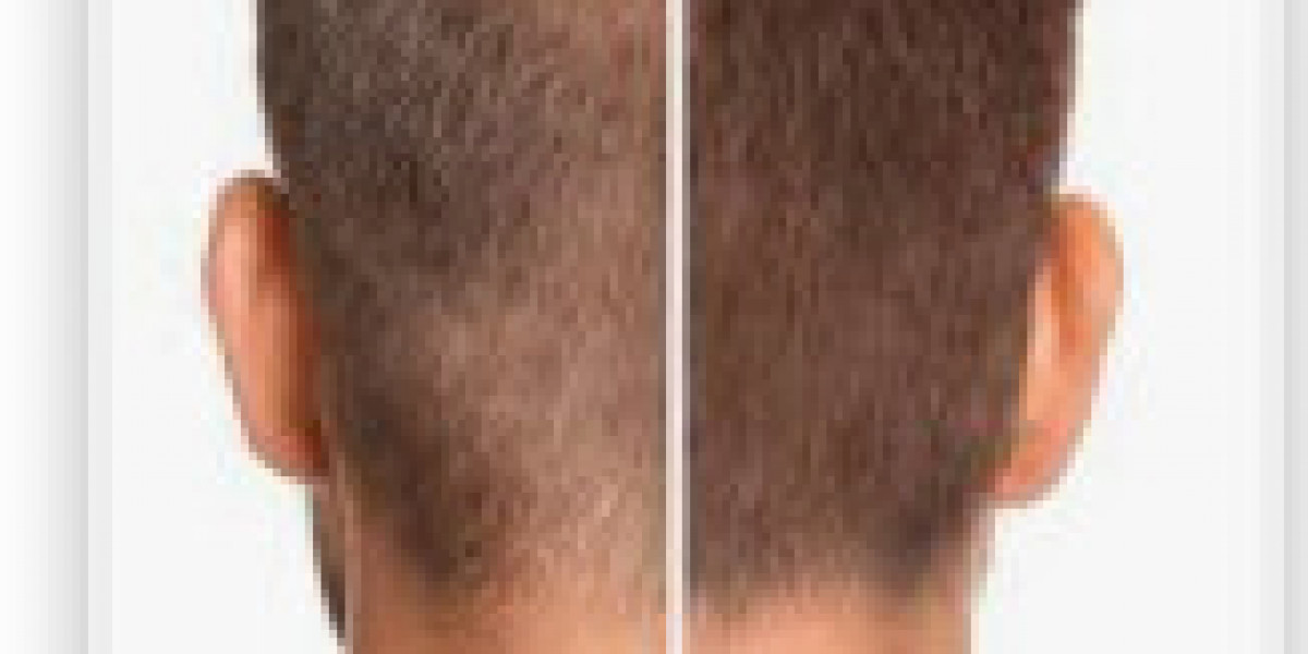Hair Fall Treatment in Mira Road: Restore Your Hair, Restore Your Confidence