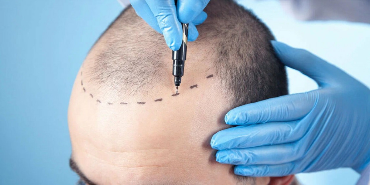 Cost of combining hair transplant with PRP therapy in Riyadh