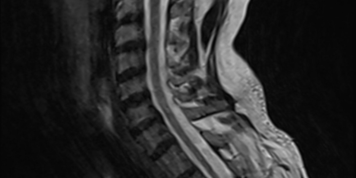 Adrenomyeloneuropathy Competitive Landscape Analysis 2035