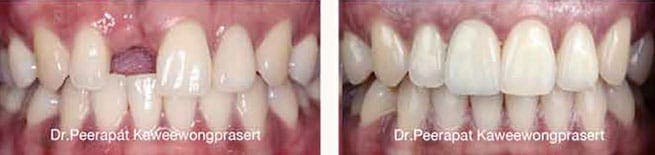 Dental Treatments in Bangkok – Bangkok Health Service