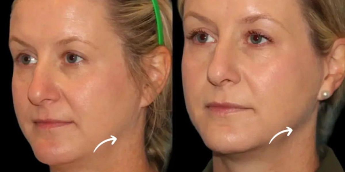 Best Doctors in Dubai for Sculptra Fillers Chin Dimple Treatment