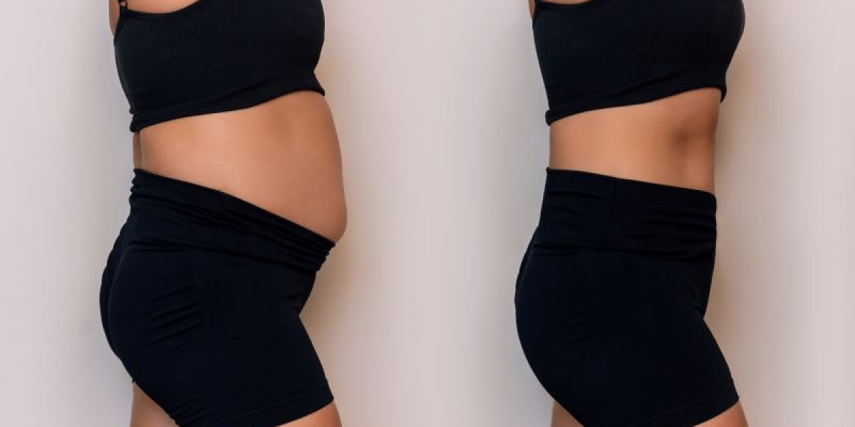 Can Vaser 4D Liposuction Sculpt Every Curve Into Perfect, Mind-Blowing Definition