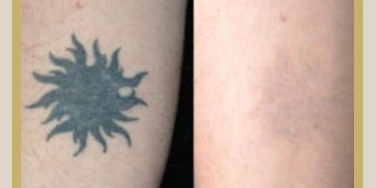 Laser Tattoo Removal in Islamabad with Minimal Pain