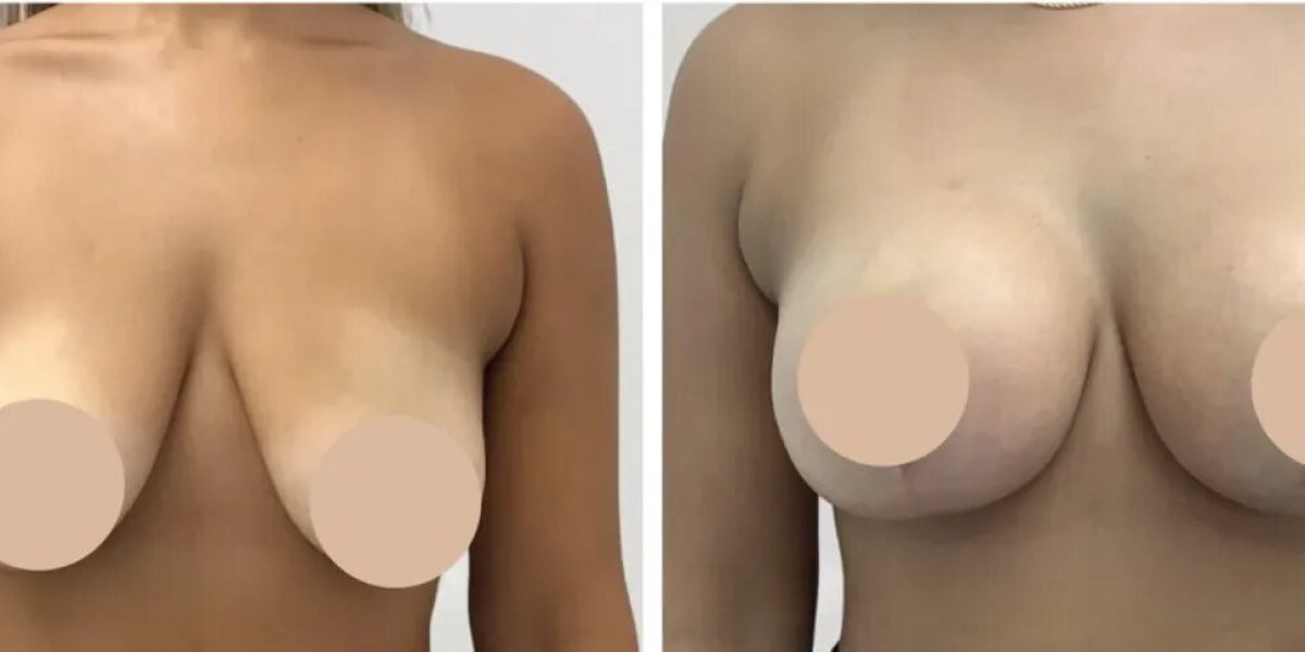 Transform Your Body with Breast Reduction: Top Best Doctors in Dubai