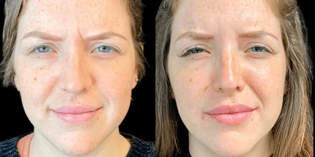 Botox for all ages by Best Plastic Surgeons in Dubai