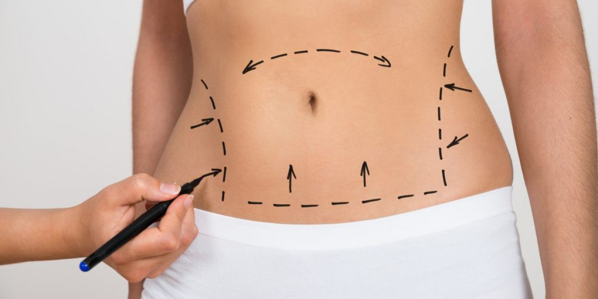 Liposuction in Islamabad – Minimal Downtime Procedure