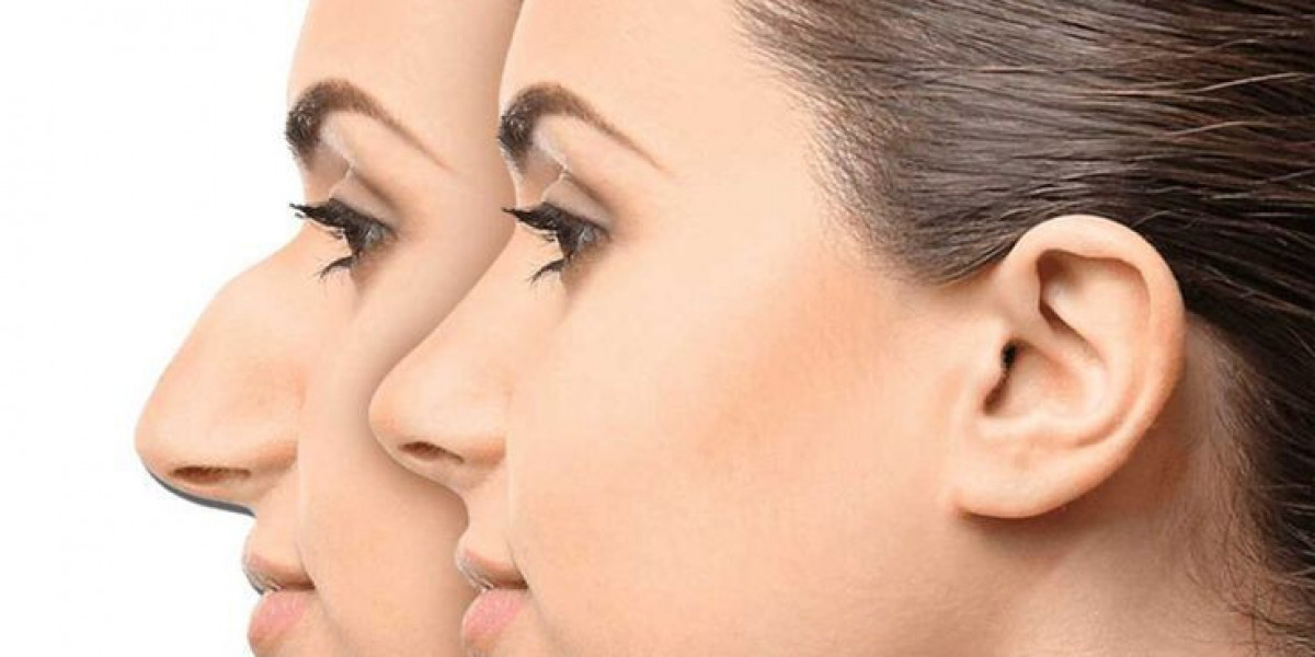 Rhinoplasty in Islamabad for Subtle Changes