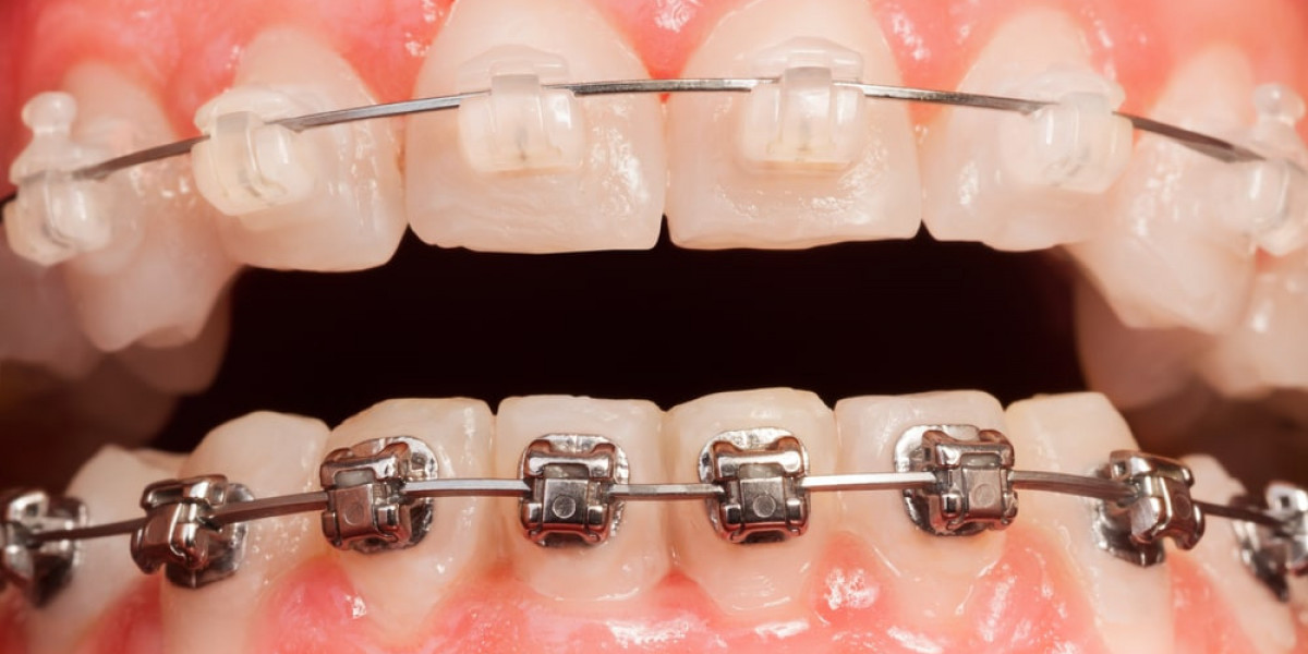 Dental Veneers Sunbury: Transform Your Smile with Modern Cosmetic Dentistry