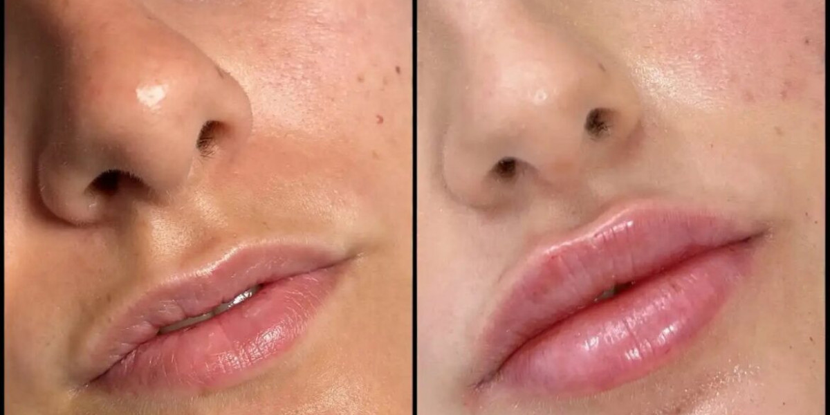 Best Aesthetic Clinics in Dubai for Fillers: Your Beauty Transformation