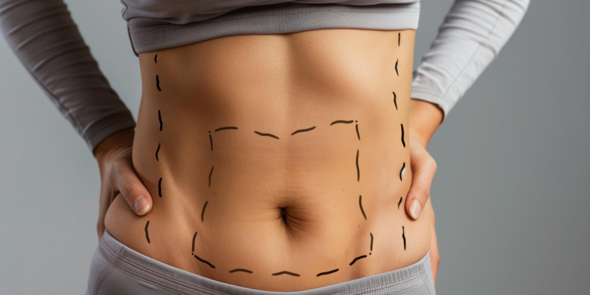 Why Is Liposuction So Popular for Fat Reduction and Contouring?