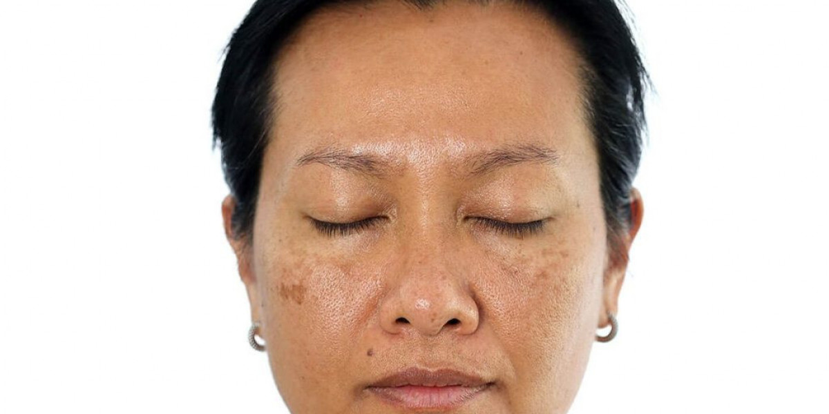 How Does Fractional CO2 Laser Treatment Improve Skin Texture Naturally?